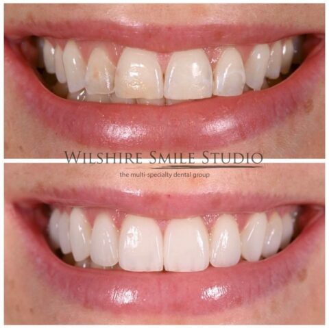 Worn, uneven front teeth made smooth with veneers