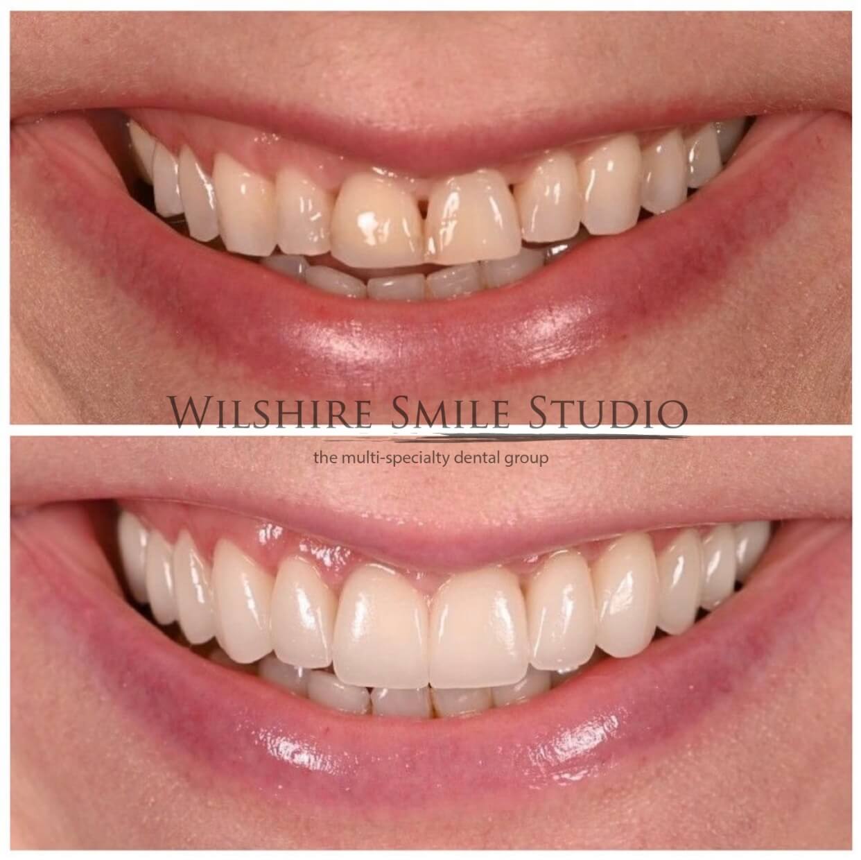 Dental_Veneers_Wilshire_Smile_Studio_11