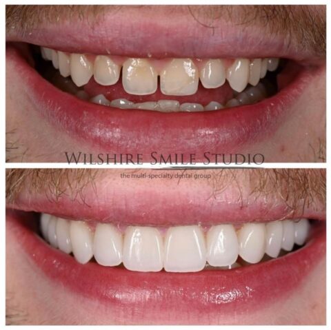 Front teeth with a gap and stains before veneers, and a closed, even smile after