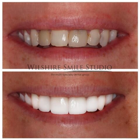Dark, discolored teeth before treatment and bright white veneers after