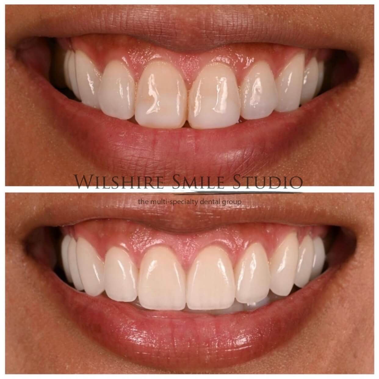 Dental_Veneers_Wilshire_Smile_Studio_2