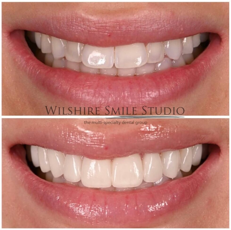 Veneers Specialist Los Angeles Wilshire Smile Studio