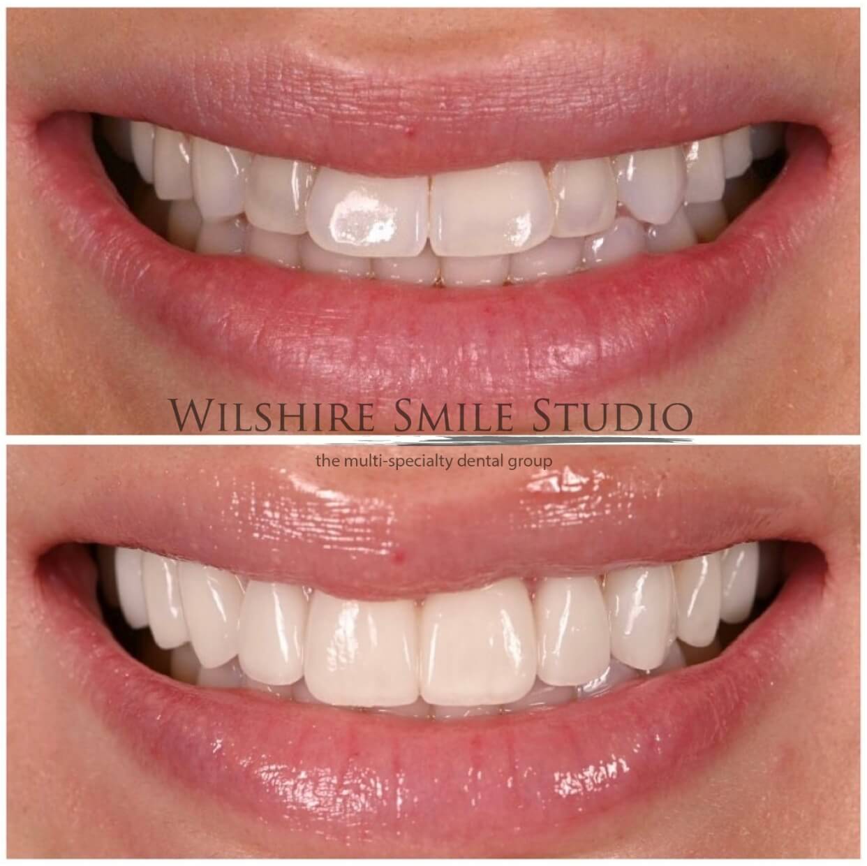 Dental_Veneers_Wilshire_Smile_Studio_3