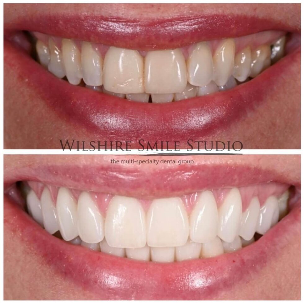 Veneers Specialist Los Angeles Wilshire Smile Studio