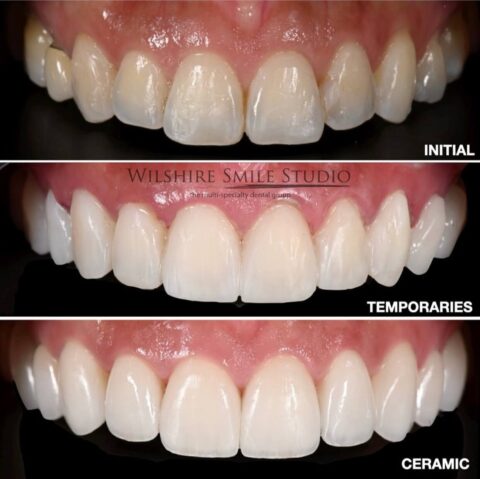 Three stages of porcelain veneers: the original teeth, temporary veneers and the finished porcelain