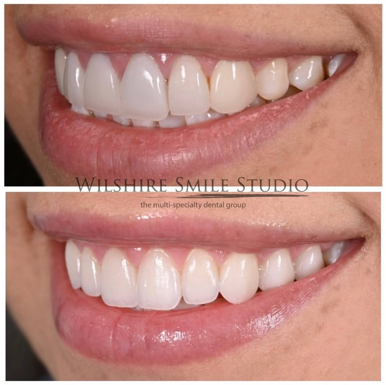 Dental_Veneers_Wilshire_Smile_Studio_8